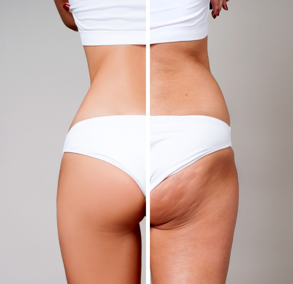 Velashape III tretman za butine i zadnjicu