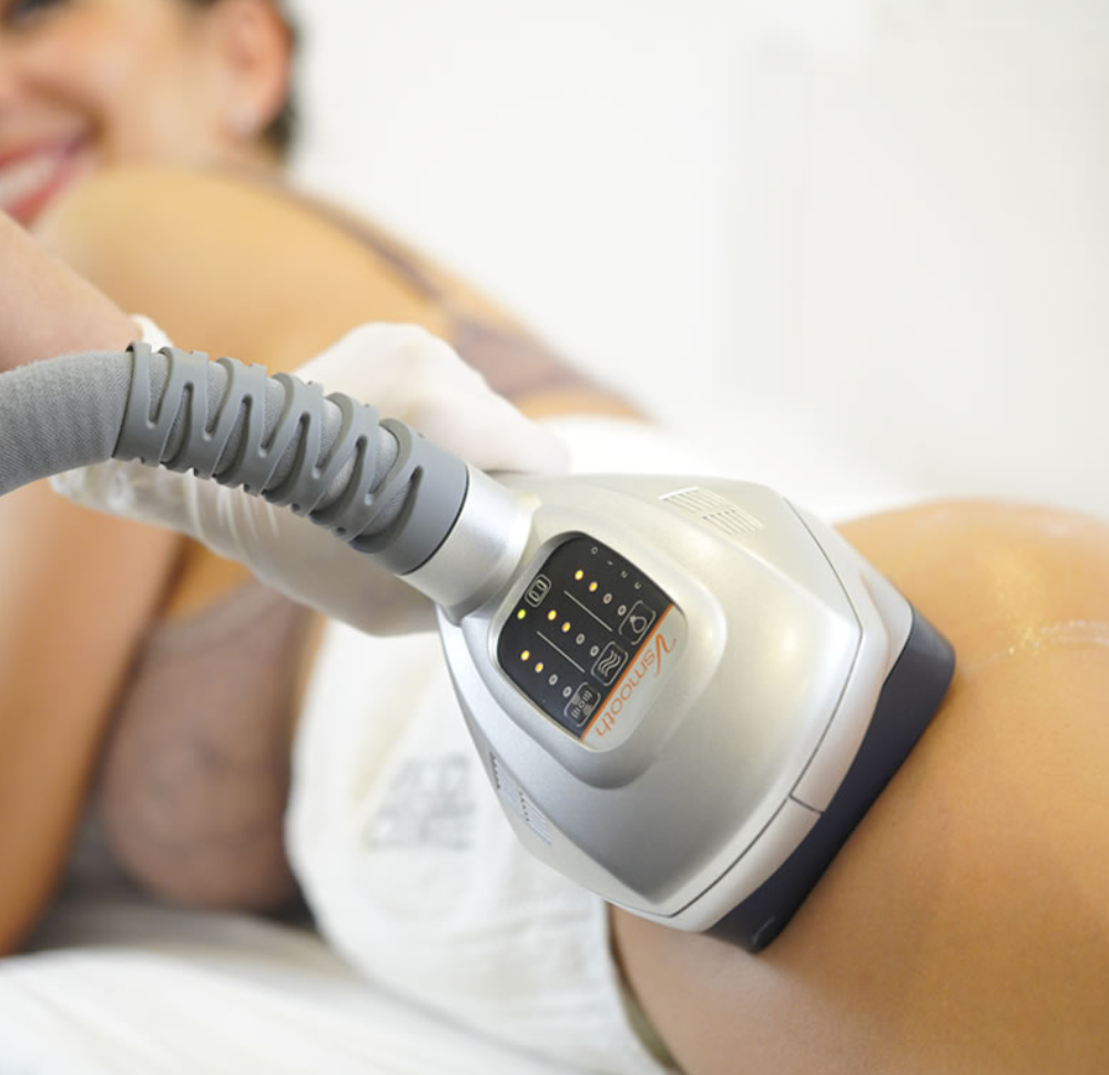 Velashape III tretman za butine i zadnjicu