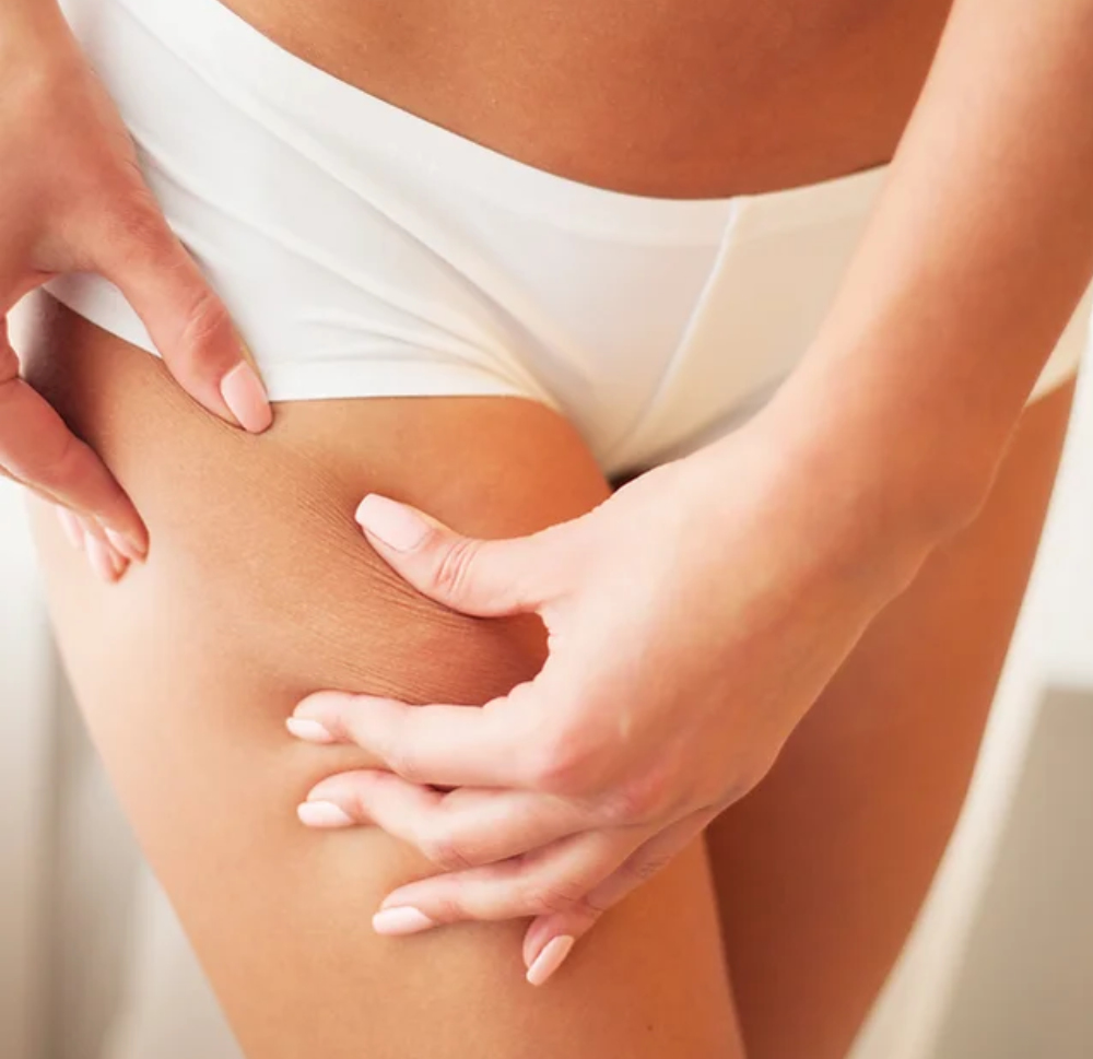 Velashape III tretman za butine i zadnjicu