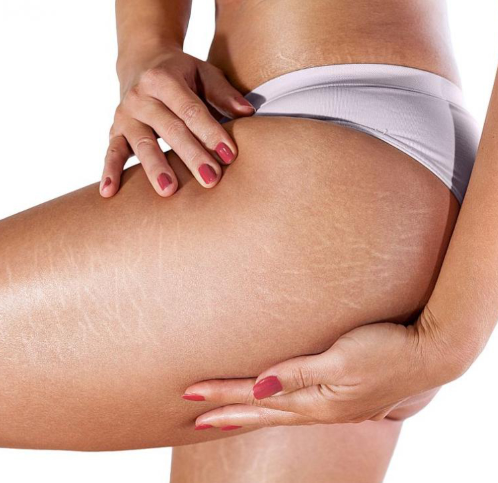 Velashape III tretman za butine i zadnjicu