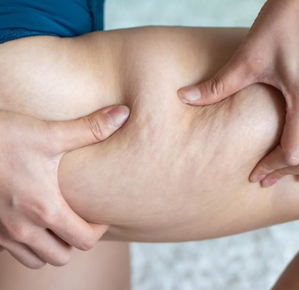 Velashape III tretman za butine i zadnjicu